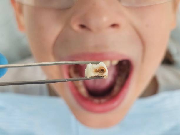 Best Emergency Tooth Extraction in Greenville, MS